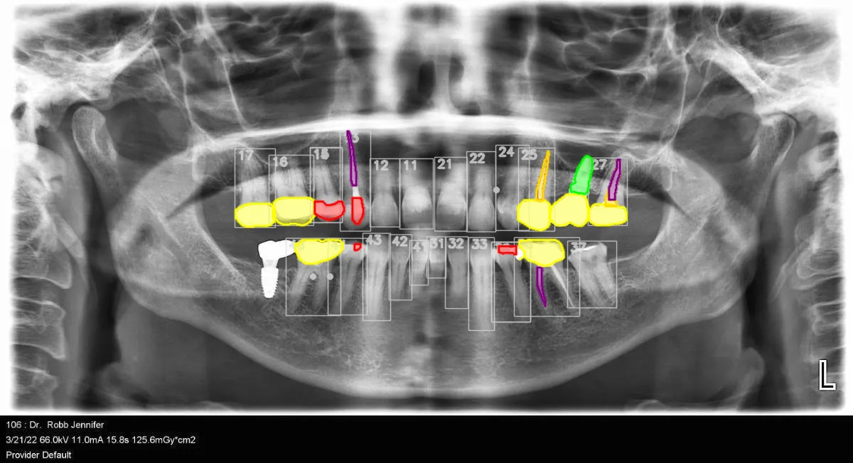 Actual annotated X-ray output, with tooth masks and treatment findings.